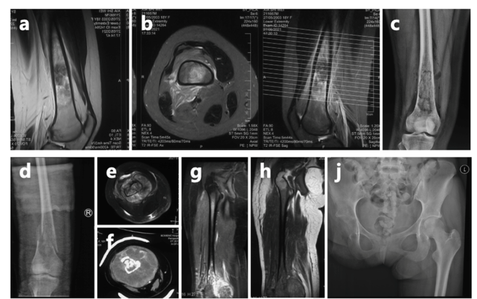 皇冠信用盘代理_女孩高考晕倒确诊骨癌！自己签字进行6次手术截肢皇冠信用盘代理，上海医生全力救治
